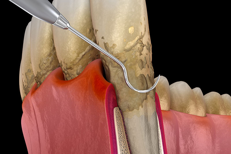 Gum Disease in Waterford